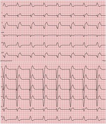 Case report: Successful extracorporeal cardiopulmonary resuscitation despite severe metabolic acidosis after refractory out-of-hospital cardiac arrest